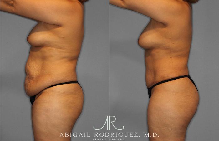Before & After Tummy Tuck Case 254867 View 3 View in Houston, TX