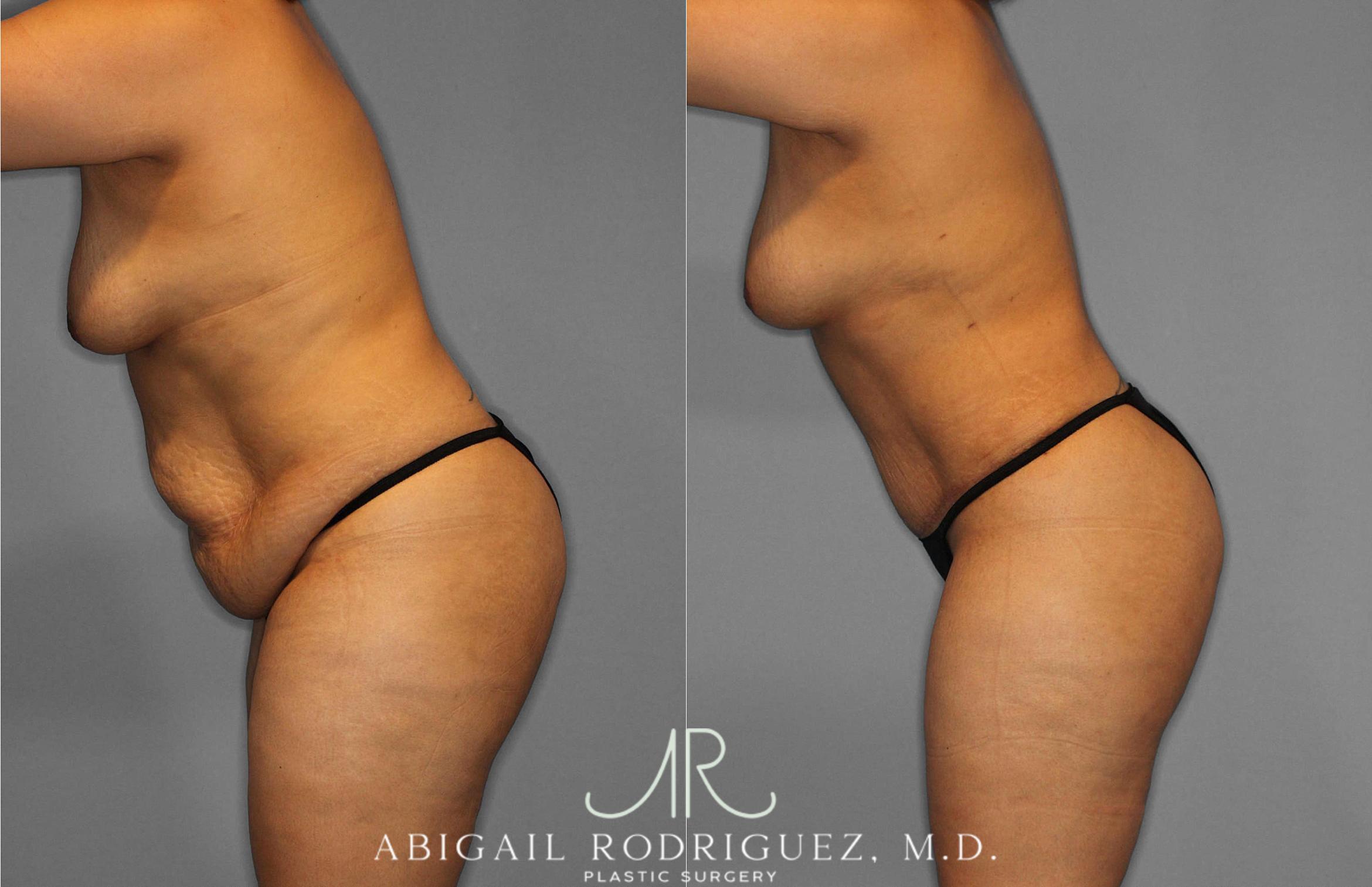 Before & After Tummy Tuck Case 254867 View 4 View in Houston, TX
