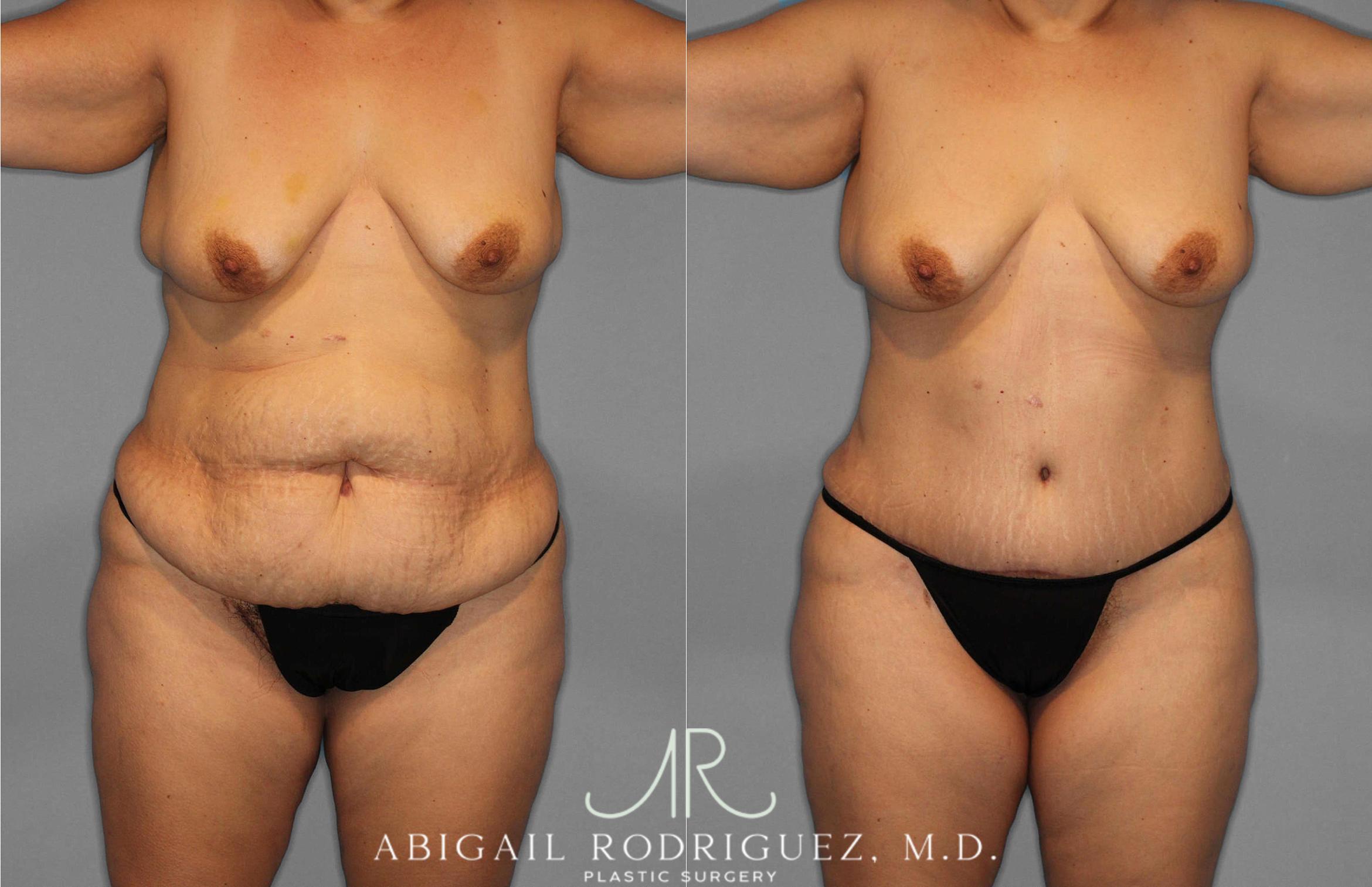 Before & After Tummy Tuck Case 254868 View 1 View in Houston, TX