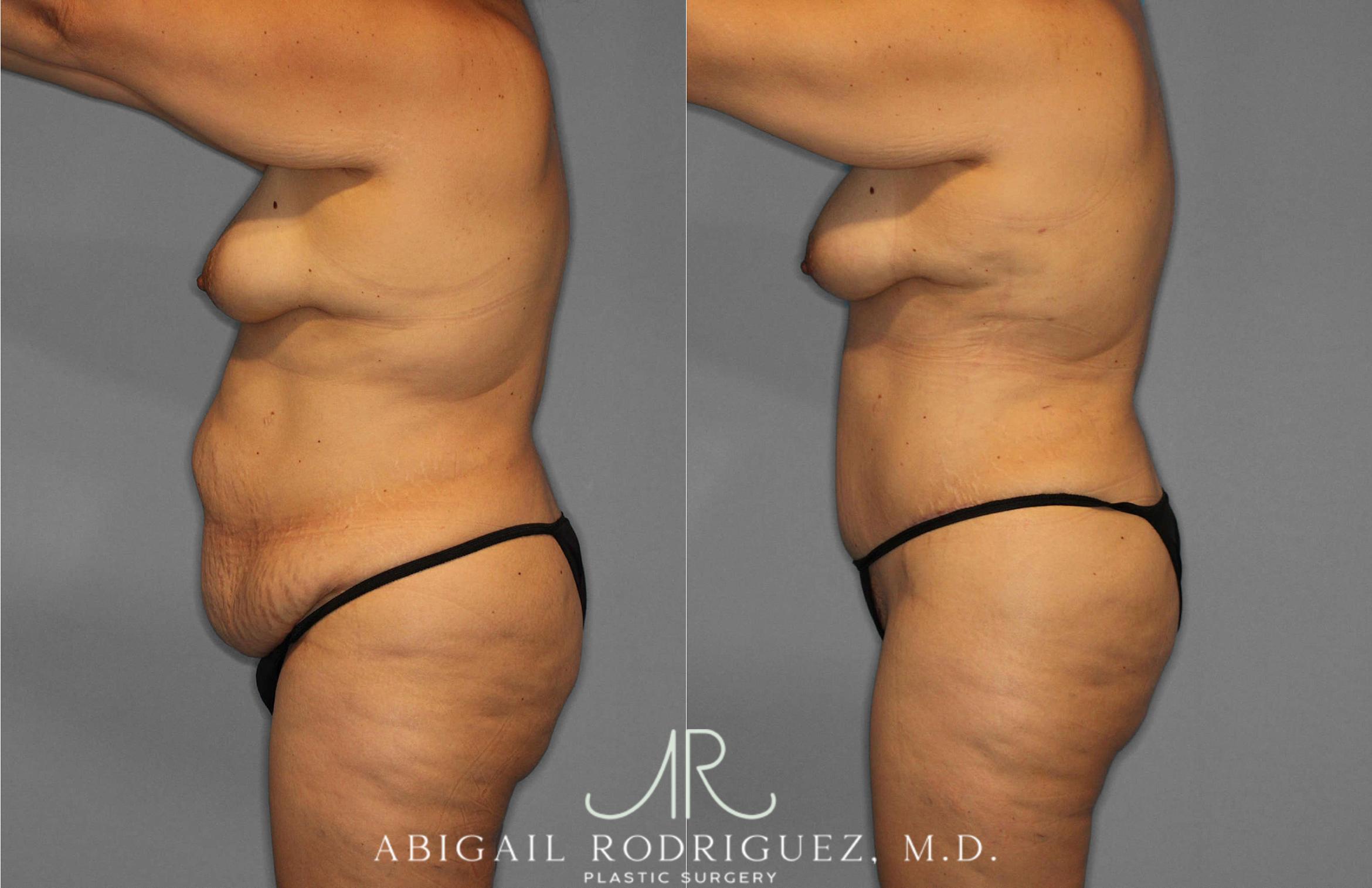 Before & After Tummy Tuck Case 254868 View 3 View in Houston, TX