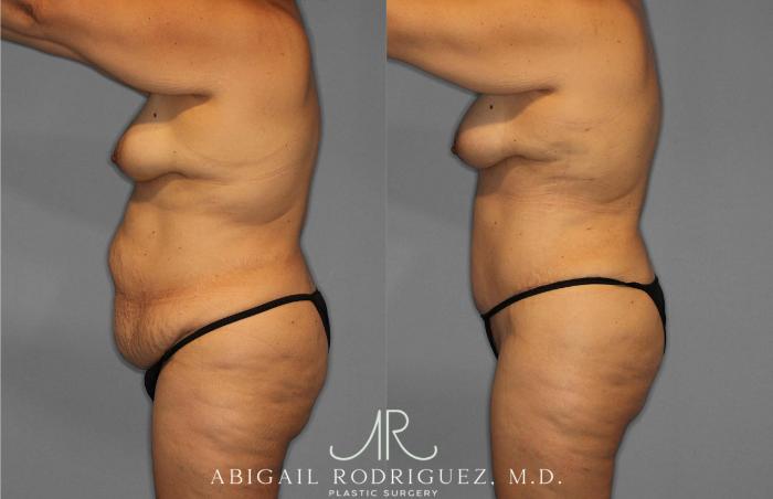 Before & After Tummy Tuck Case 254868 View 3 View in Houston, TX