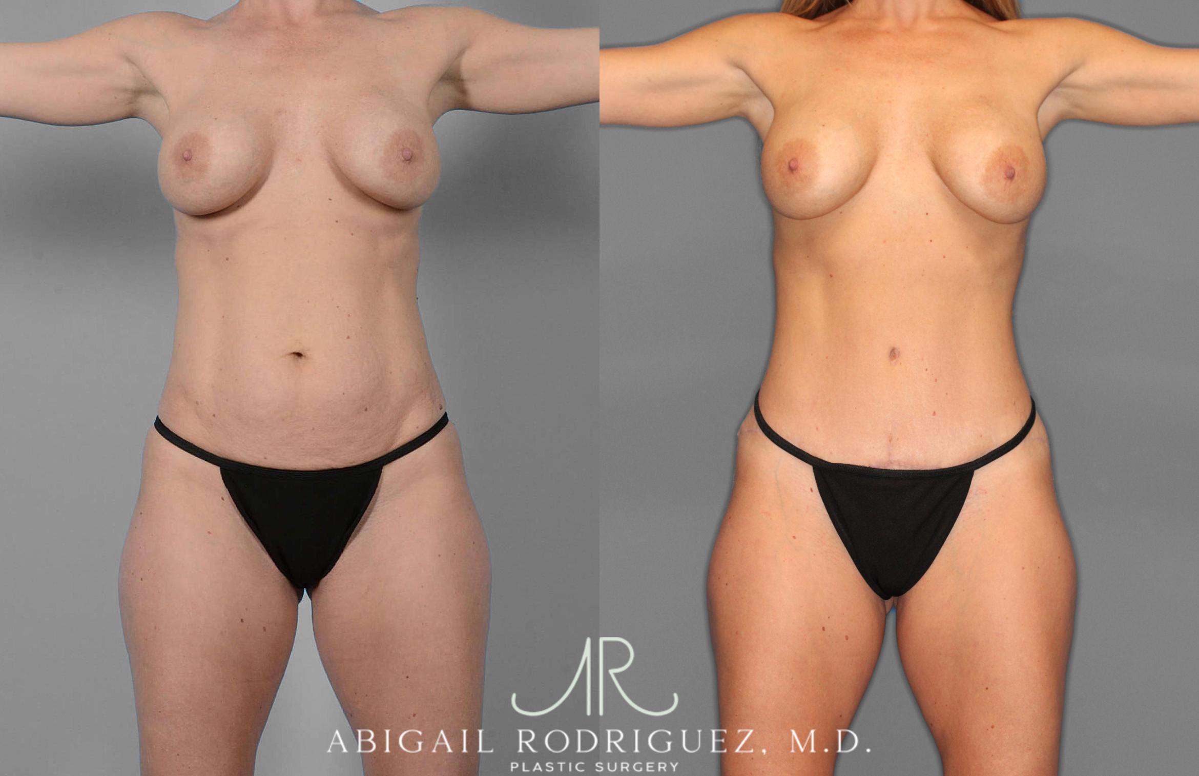 Before & After Tummy Tuck Case 254869 View 1 View in Houston, TX