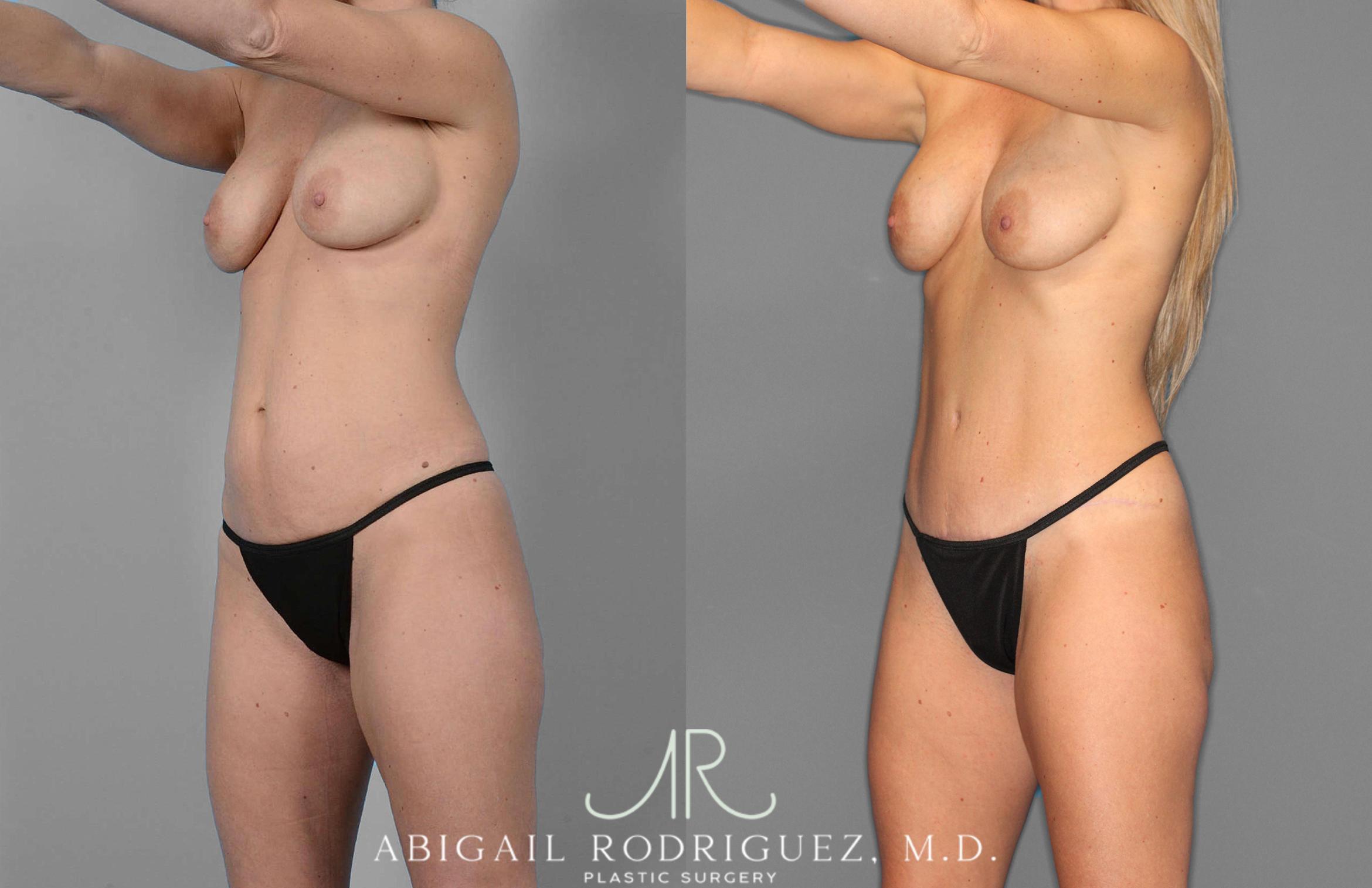 Before & After Tummy Tuck Case 254869 View 2 View in Houston, TX