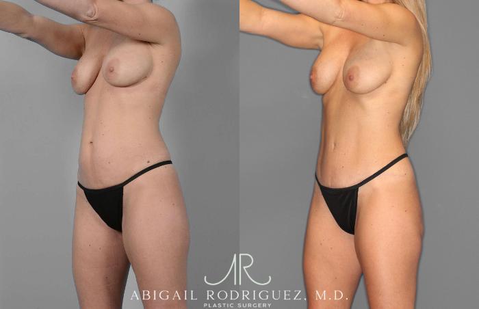 Before & After Tummy Tuck Case 254869 View 2 View in Houston, TX
