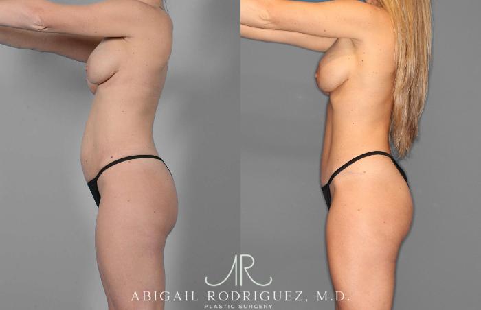 Before & After Tummy Tuck Case 254869 View 3 View in Houston, TX