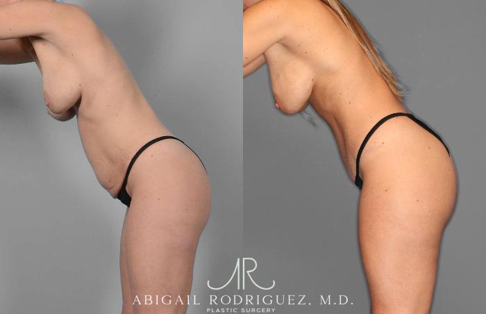 Before & After Tummy Tuck Case 254869 View 4 View in Houston, TX