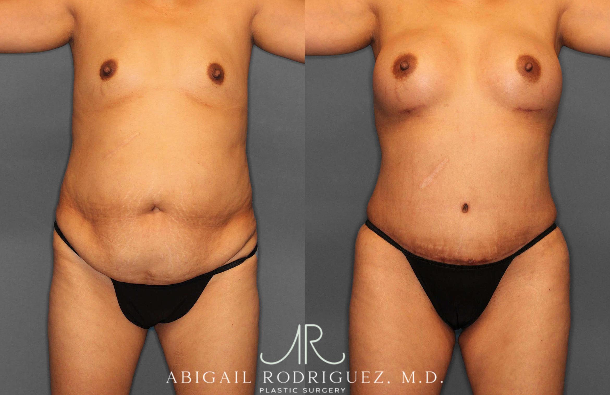 Before & After Tummy Tuck Case 254920 View 1 View in Houston, TX