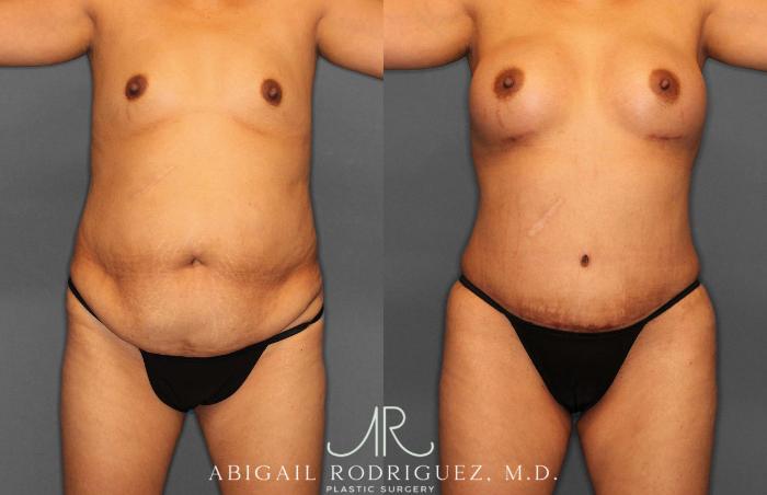 Before & After Fat Grafting Case 254920 View 1 View in Houston, TX