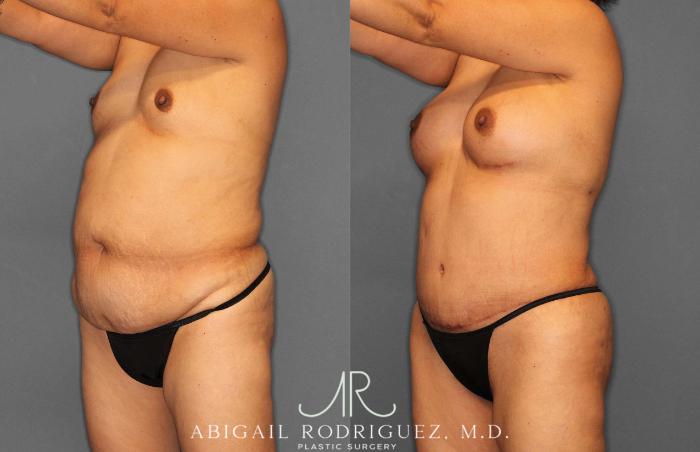 Before & After Tummy Tuck Case 254920 View 2 View in Houston, TX