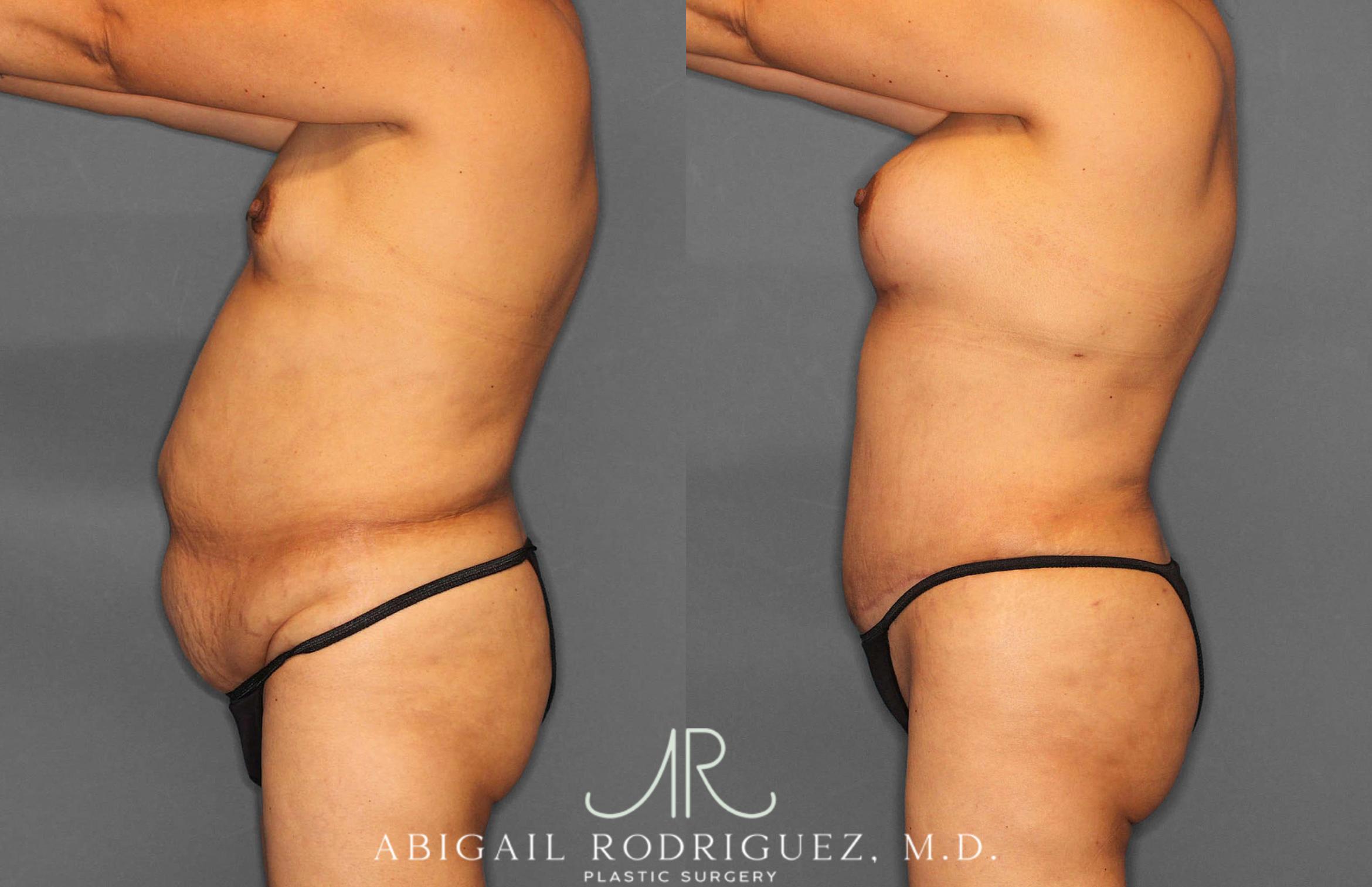 Before & After Tummy Tuck Case 254920 View 3 View in Houston, TX