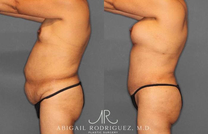 Before & After Tummy Tuck Case 254920 View 3 View in Houston, TX