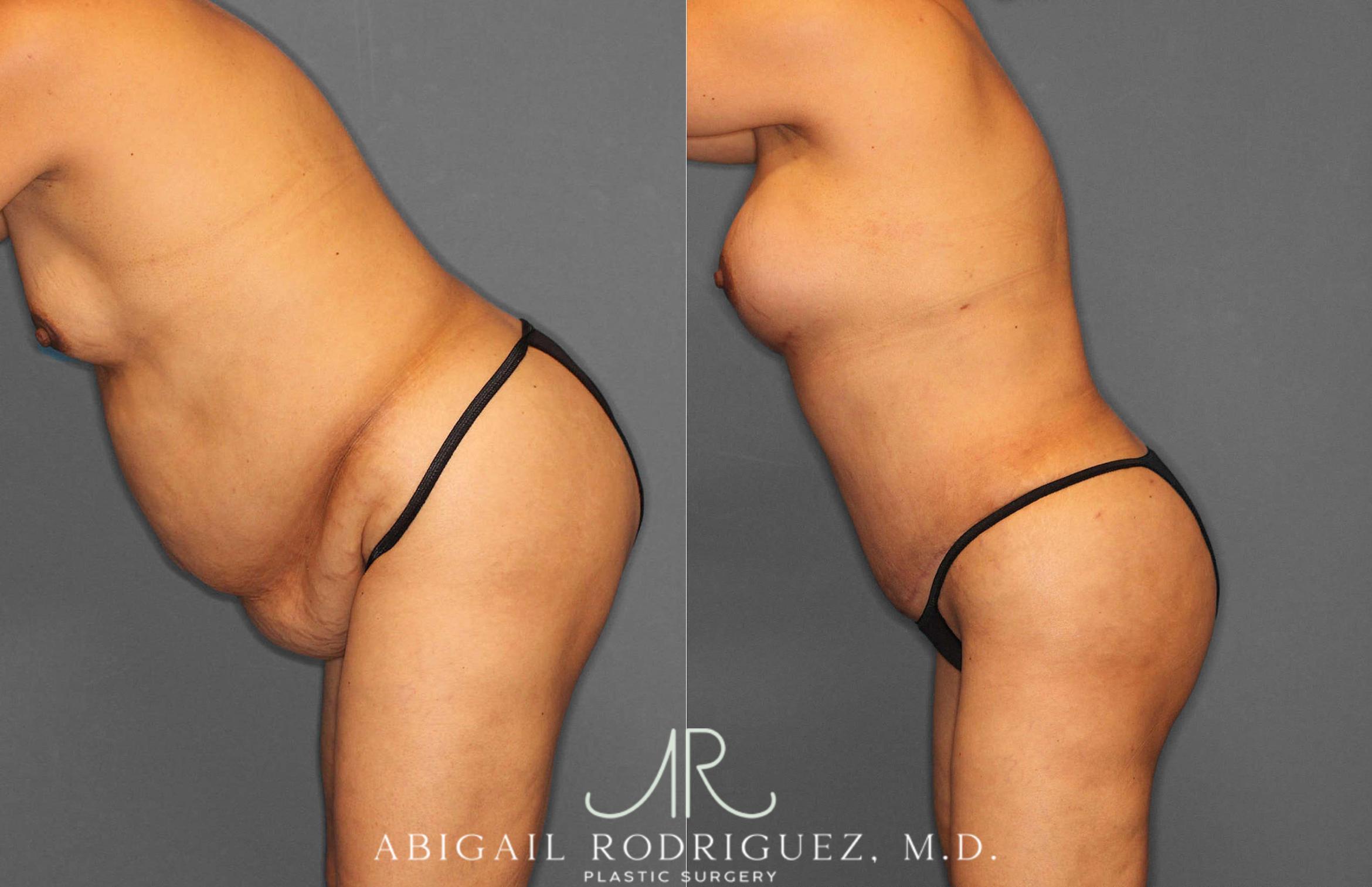 Before & After Tummy Tuck Case 254920 View 4 View in Houston, TX