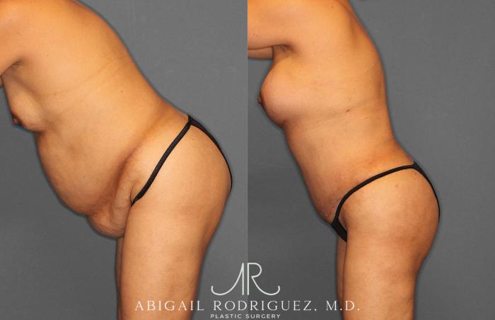 Before & After Tummy Tuck Case 254920 View 4 View in Houston, TX