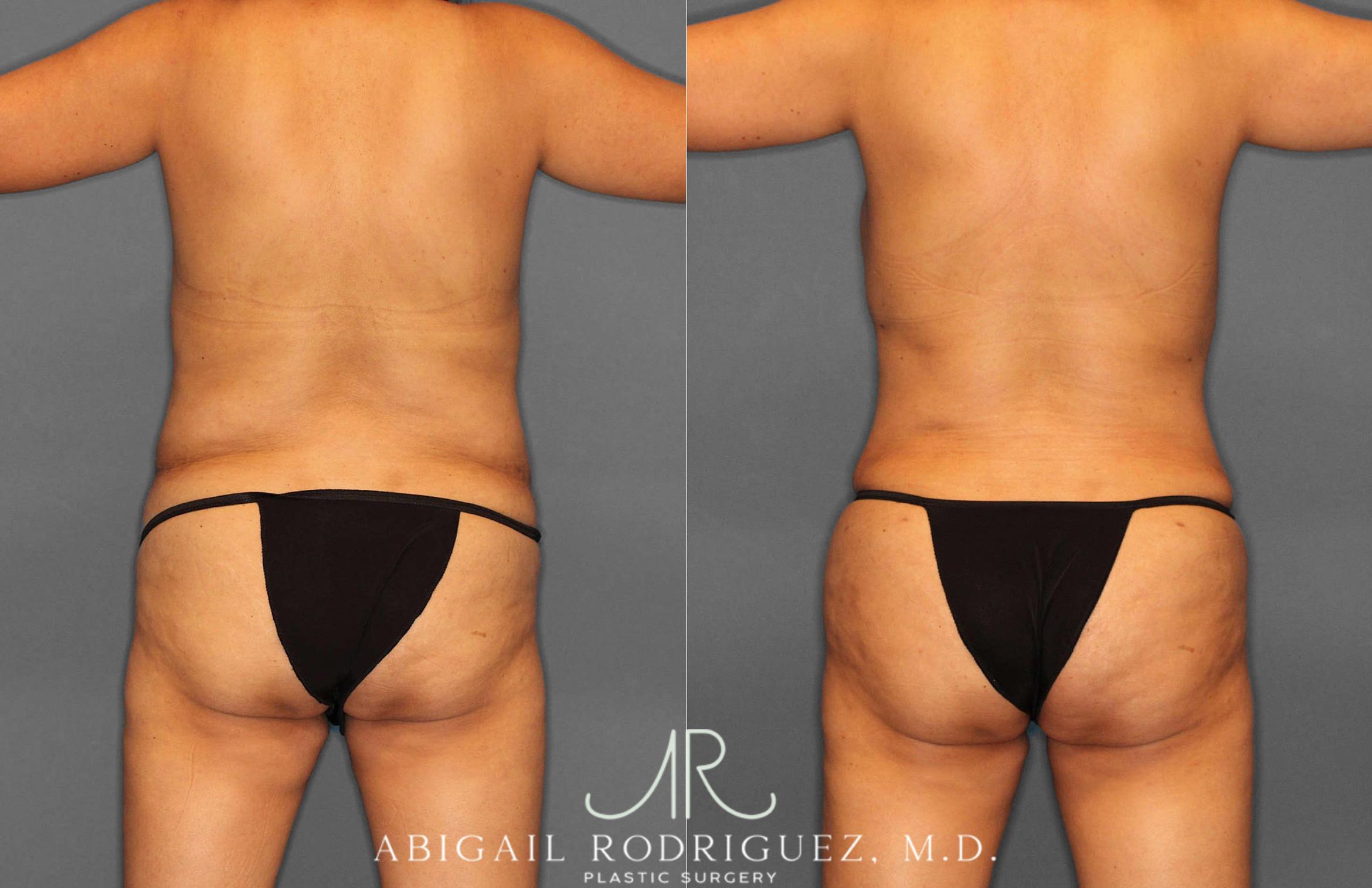 Before & After Tummy Tuck Case 254920 View 5 View in Houston, TX