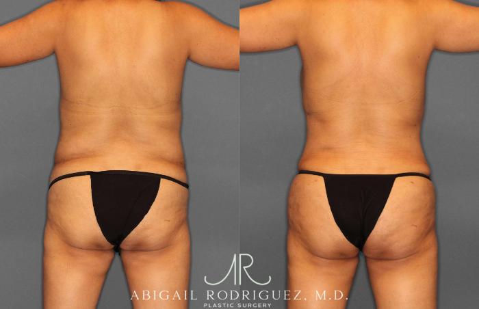 Before & After Tummy Tuck Case 254920 View 5 View in Houston, TX