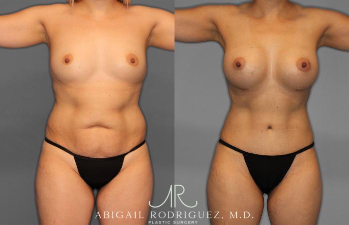 Before & After Tummy Tuck Case 257284 View 1 View in Houston, TX