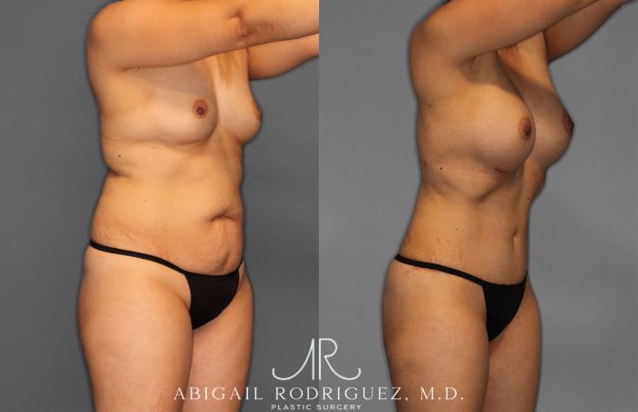 Before & After Tummy Tuck Case 257284 View 10 View in Houston, TX