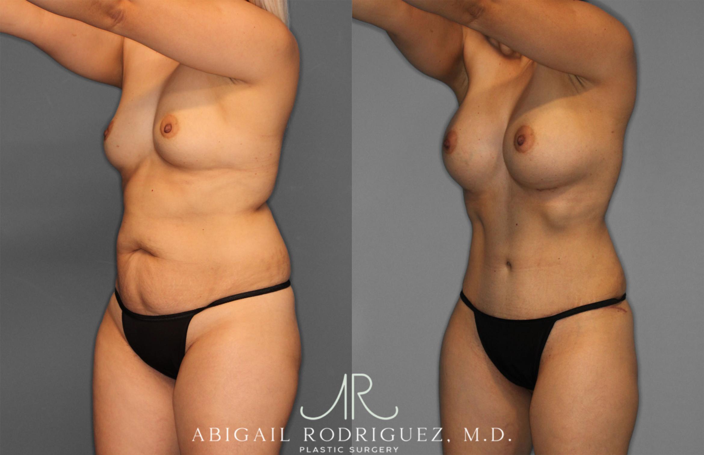 Before & After Tummy Tuck Case 257284 View 2 View in Houston, TX