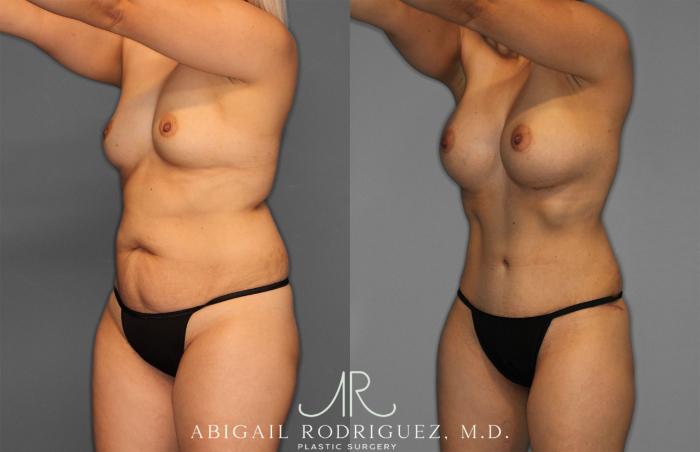 Before & After Tummy Tuck Case 257284 View 2 View in Houston, TX