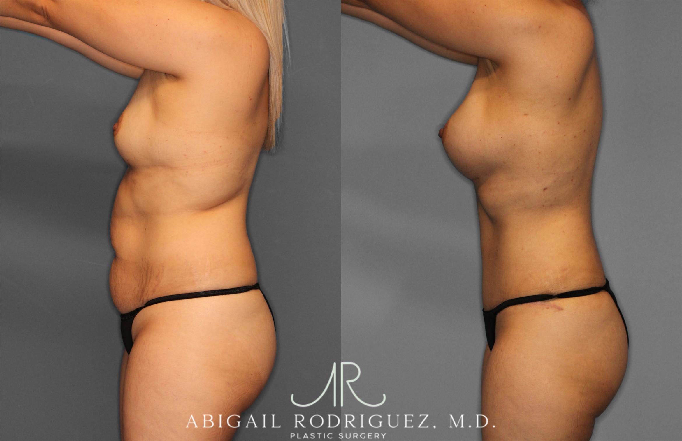 Before & After Tummy Tuck Case 257284 View 3 View in Houston, TX