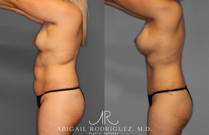 Before & After Tummy Tuck Case 257284 View 3 View in Houston, TX