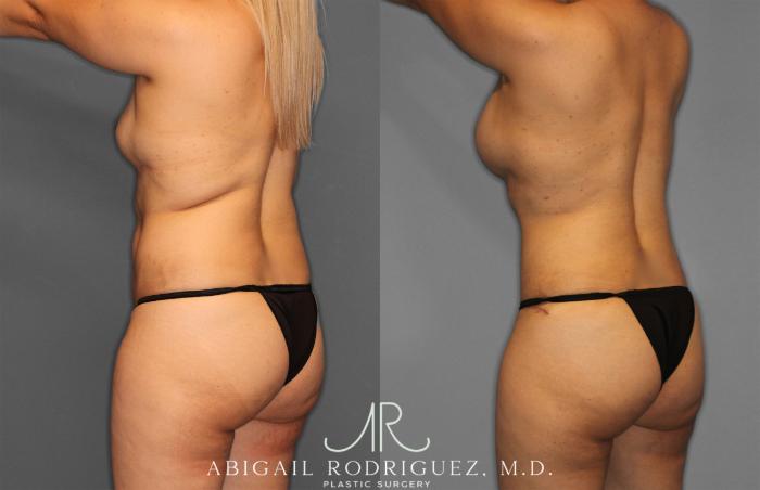 Before & After Tummy Tuck Case 257284 View 5 View in Houston, TX