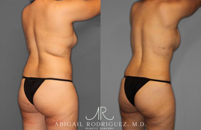 Before & After Tummy Tuck Case 257284 View 7 View in Houston, TX