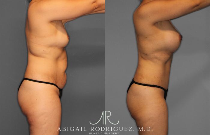 Before & After Tummy Tuck Case 257284 View 8 View in Houston, TX