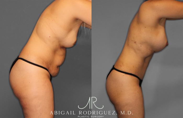 Before & After Tummy Tuck Case 257284 View 9 View in Houston, TX