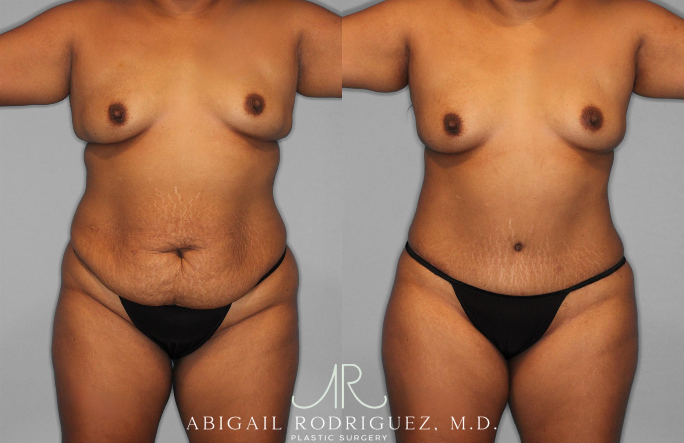 Before & After Tummy Tuck Case 257351 View 1 View in Houston, TX
