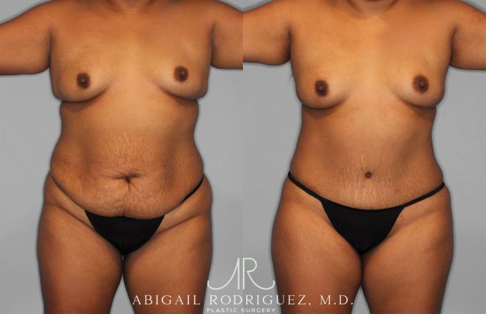 Before & After Tummy Tuck Case 257351 View 1 View in Houston, TX