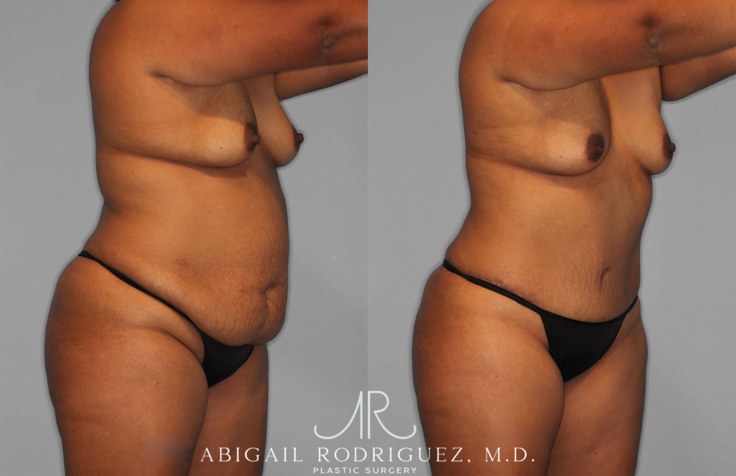 Before & After Tummy Tuck Case 257351 View 2 View in Houston, TX