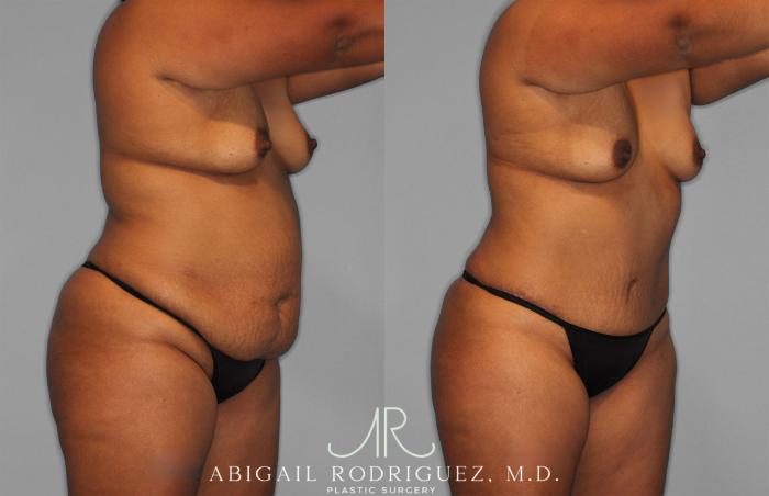 Before & After Tummy Tuck Case 257351 View 2 View in Houston, TX