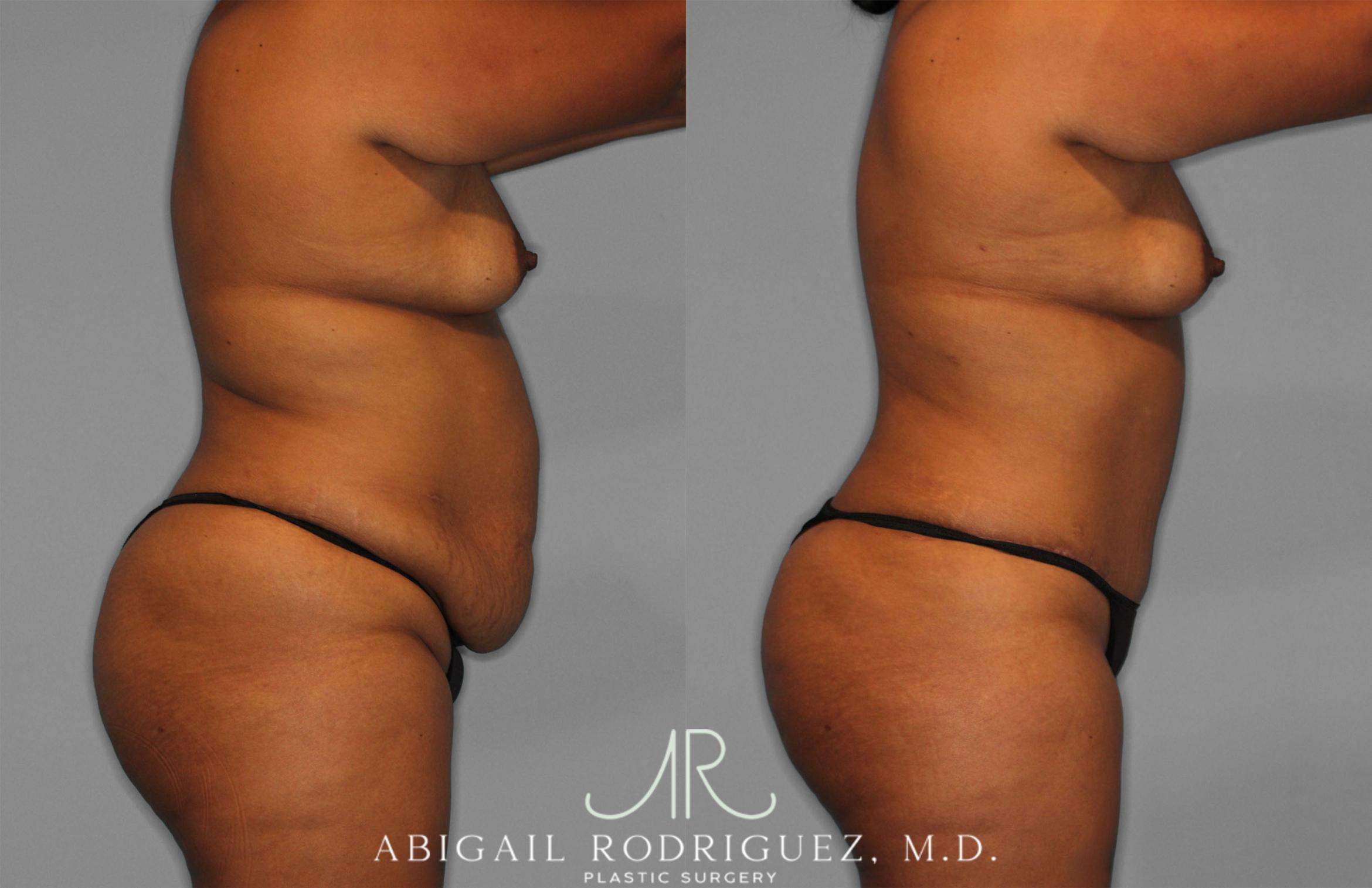 Before & After Tummy Tuck Case 257351 View 3 View in Houston, TX