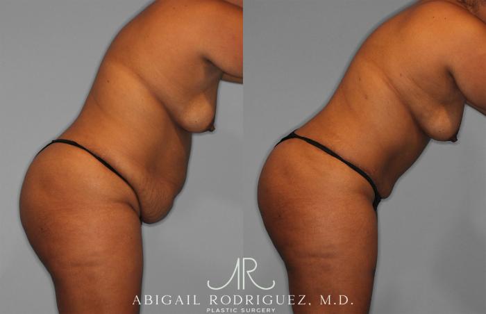 Before & After Tummy Tuck Case 257351 View 4 View in Houston, TX