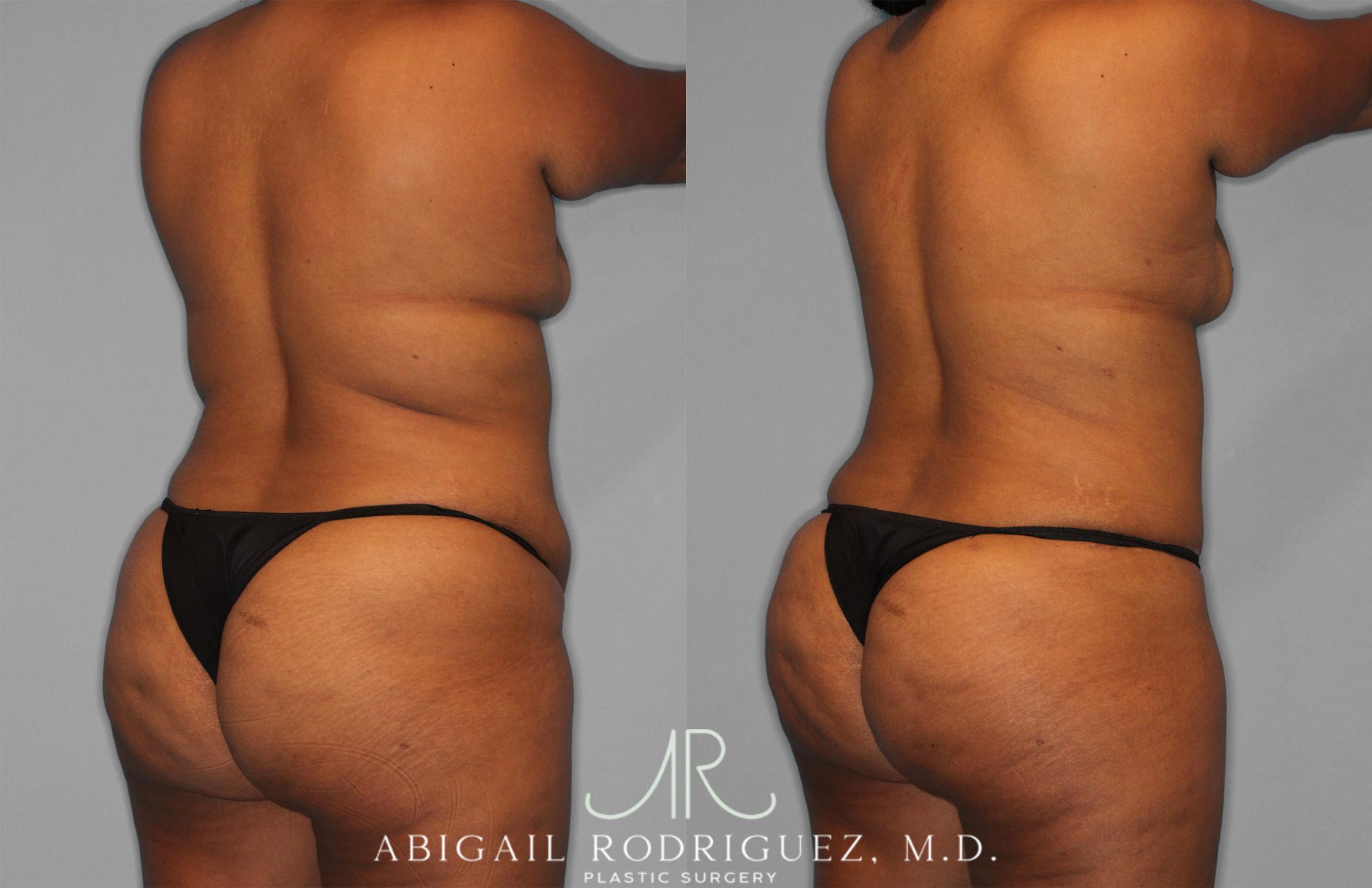 Before & After Tummy Tuck Case 257351 View 5 View in Houston, TX