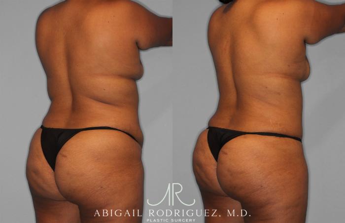Before & After Tummy Tuck Case 257351 View 5 View in Houston, TX