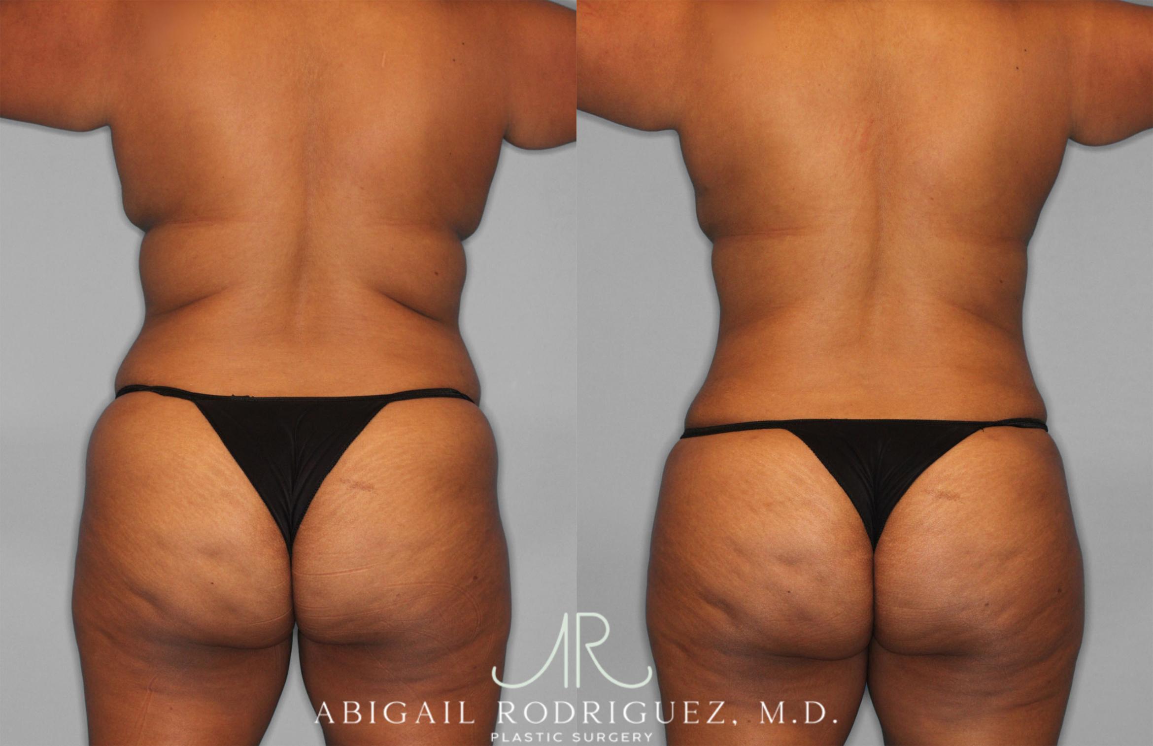 Before & After Tummy Tuck Case 257351 View 6 View in Houston, TX