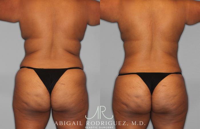 Before & After Tummy Tuck Case 257351 View 6 View in Houston, TX