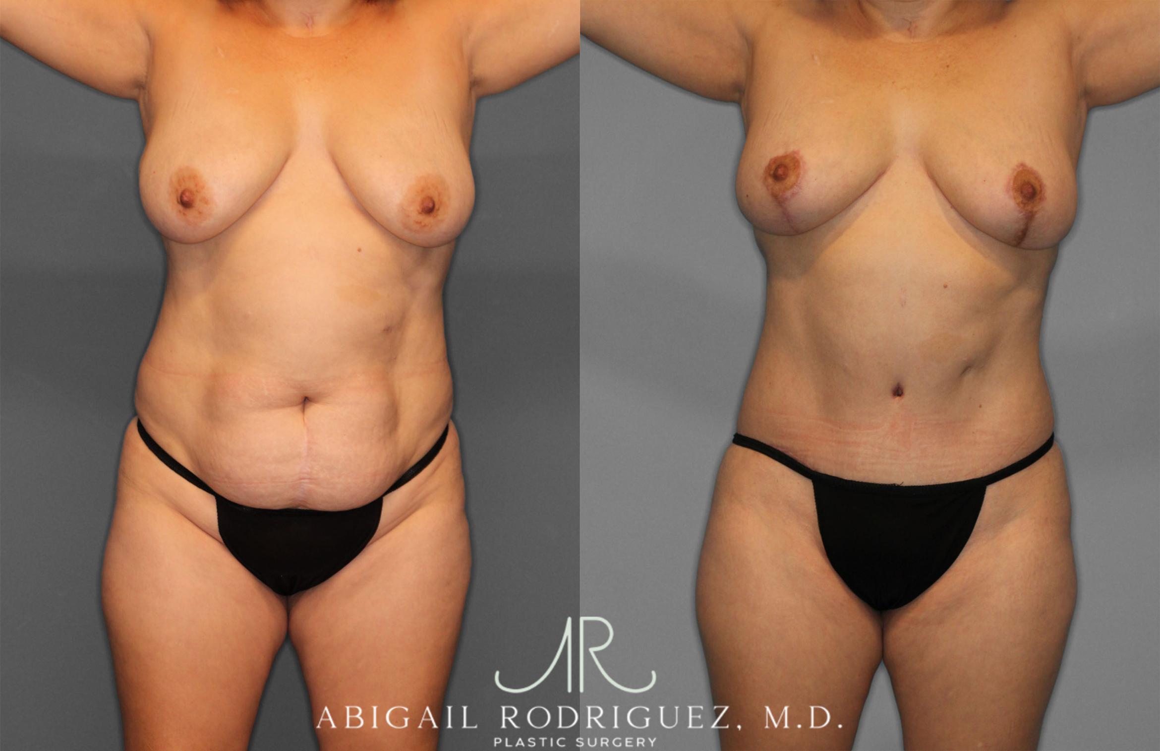 Before & After Tummy Tuck Case 257389 View 1 View in Houston, TX