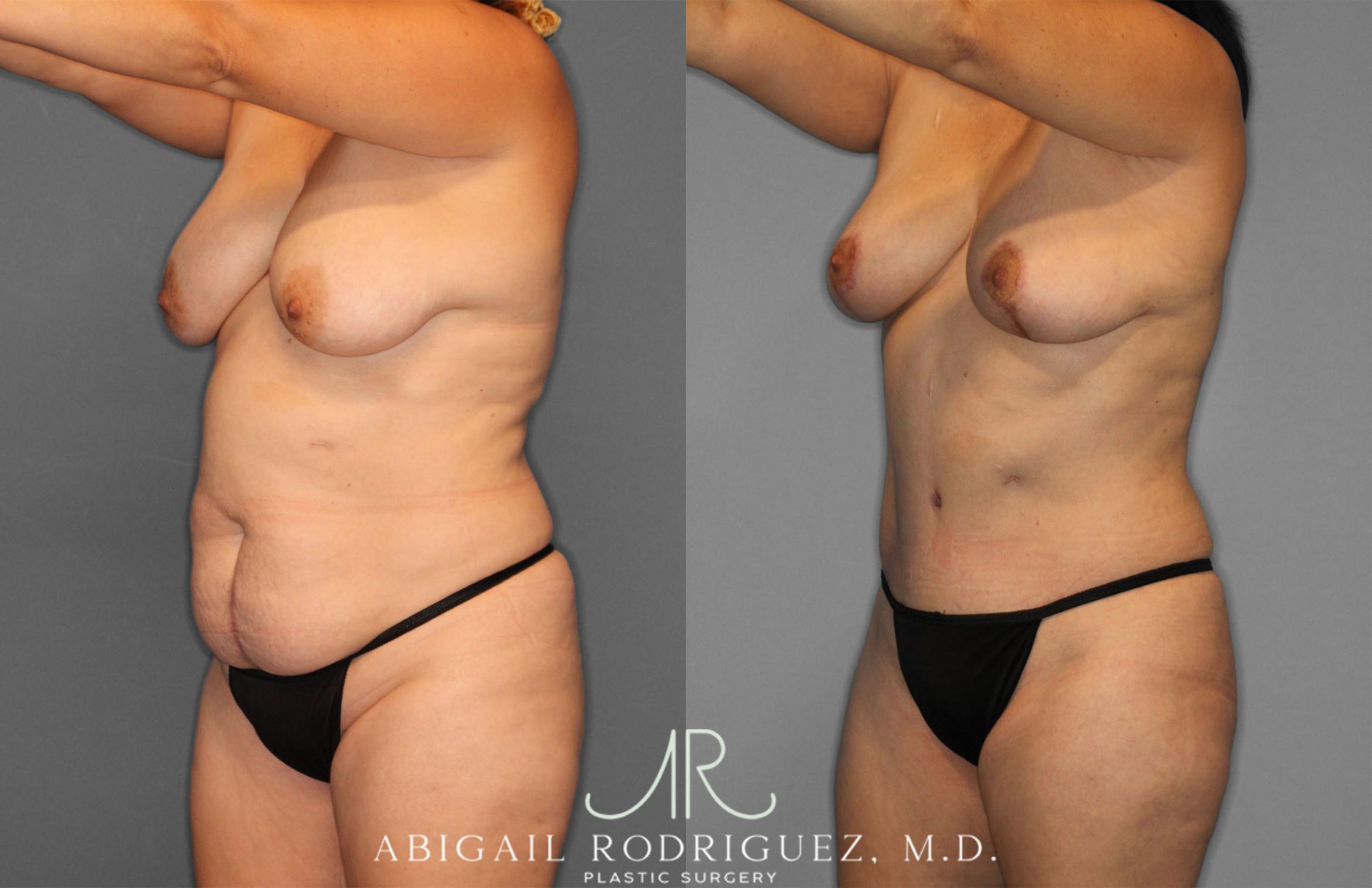 Before & After Tummy Tuck Case 257389 View 2 View in Houston, TX
