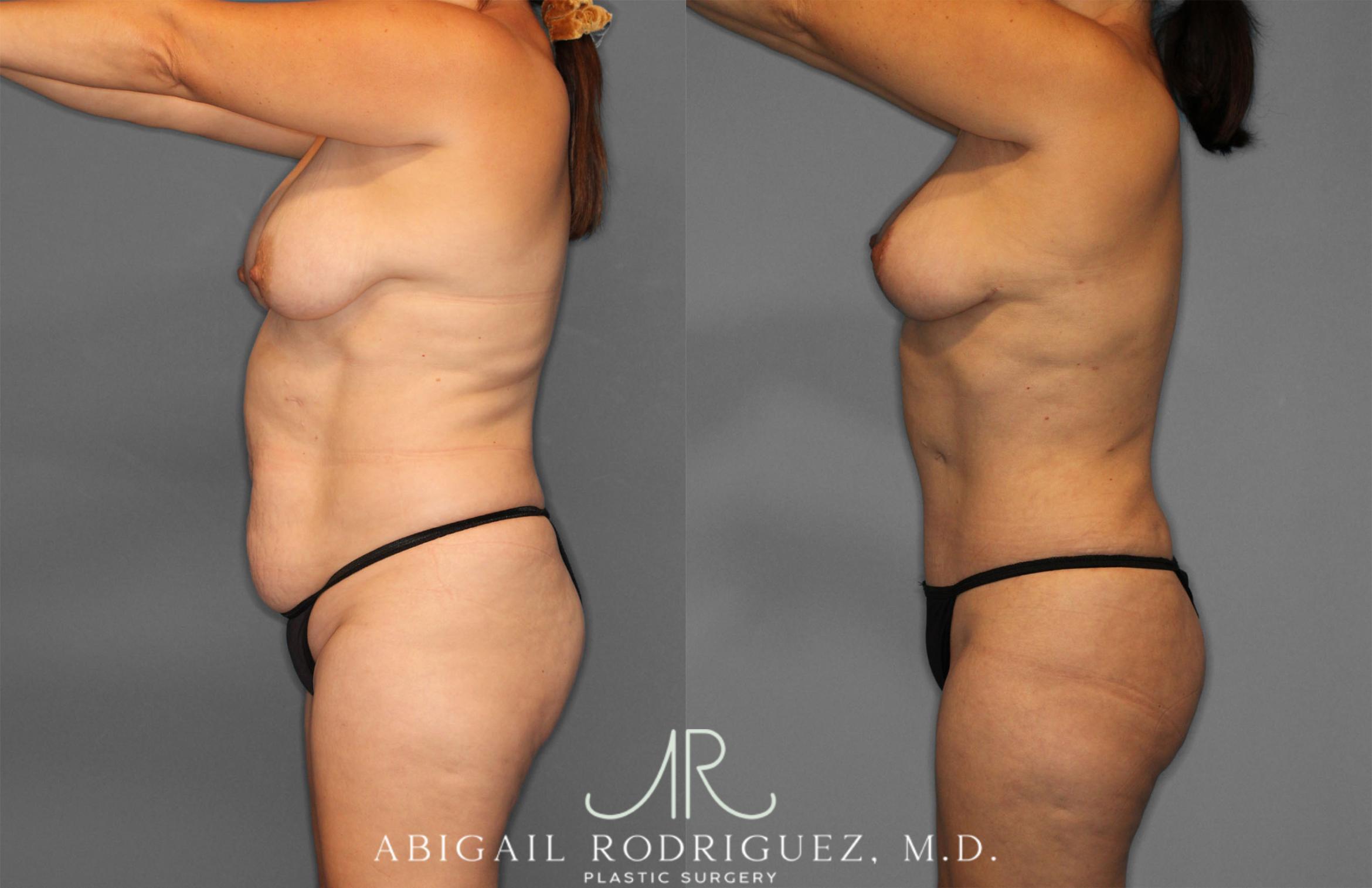 Before & After Tummy Tuck Case 257389 View 3 View in Houston, TX