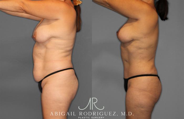 Before & After Tummy Tuck Case 257389 View 3 View in Houston, TX