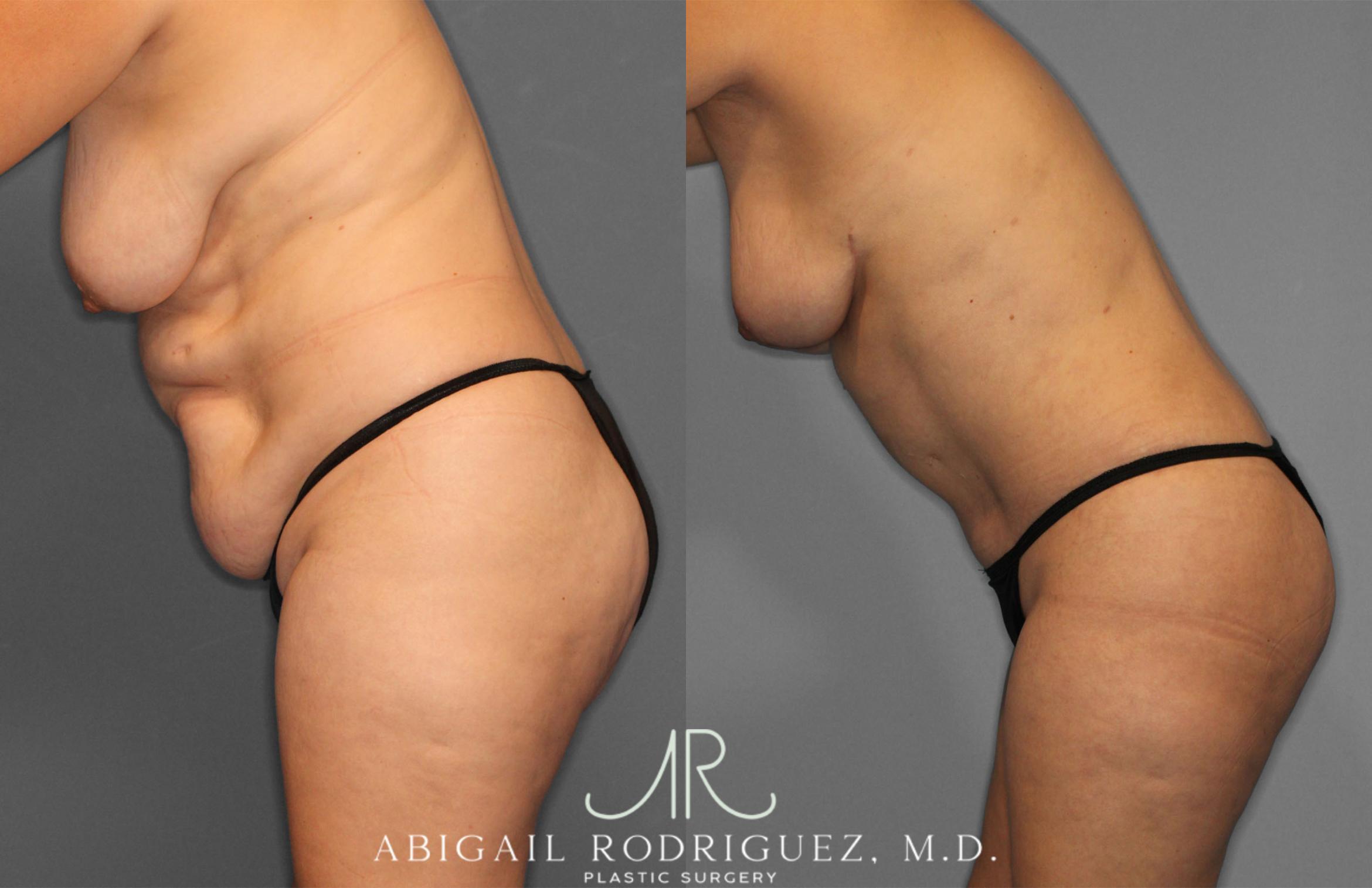 Before & After Tummy Tuck Case 257389 View 4 View in Houston, TX