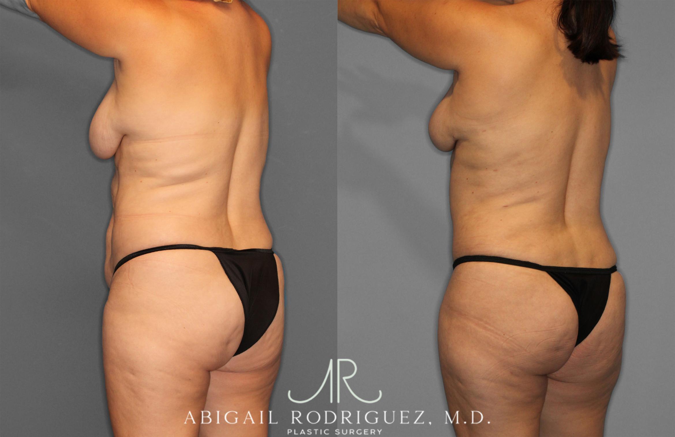 Before & After Tummy Tuck Case 257389 View 5 View in Houston, TX