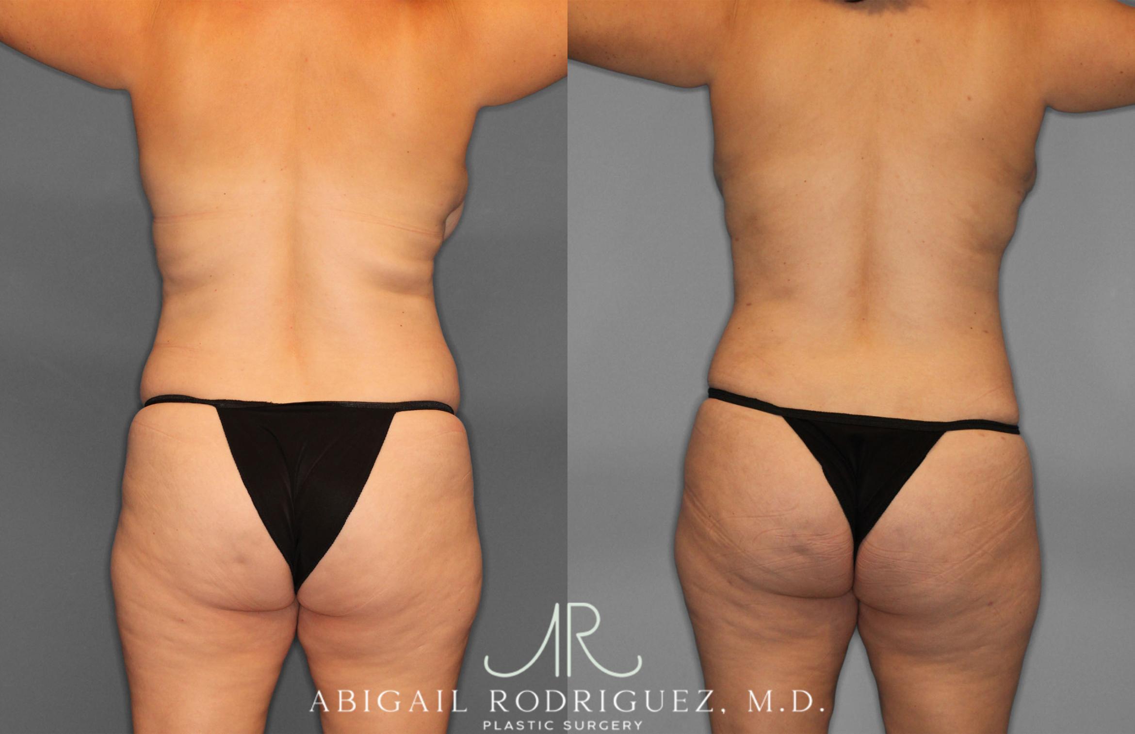Before & After Tummy Tuck Case 257389 View 6 View in Houston, TX