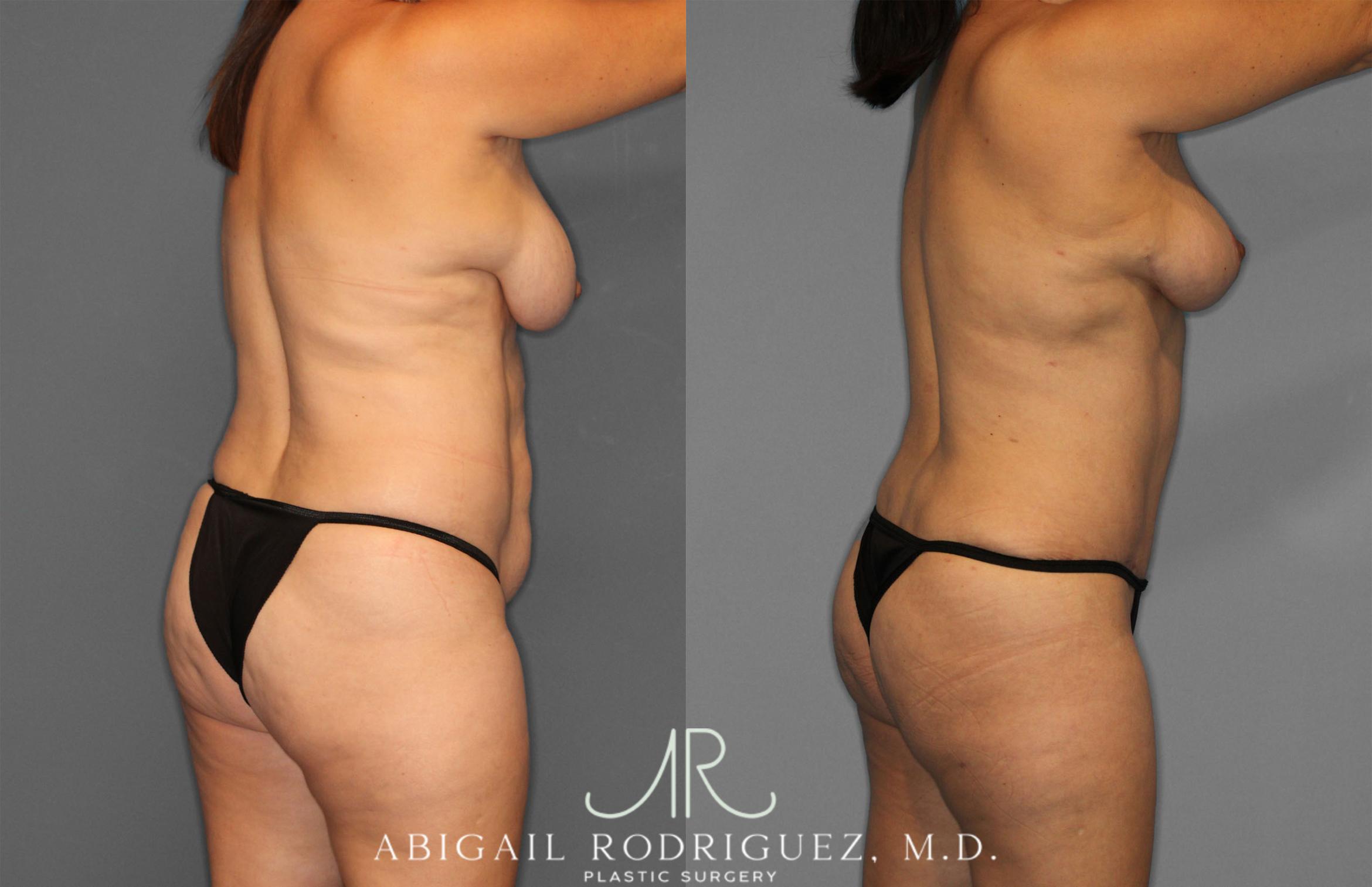 Before & After Tummy Tuck Case 257389 View 7 View in Houston, TX