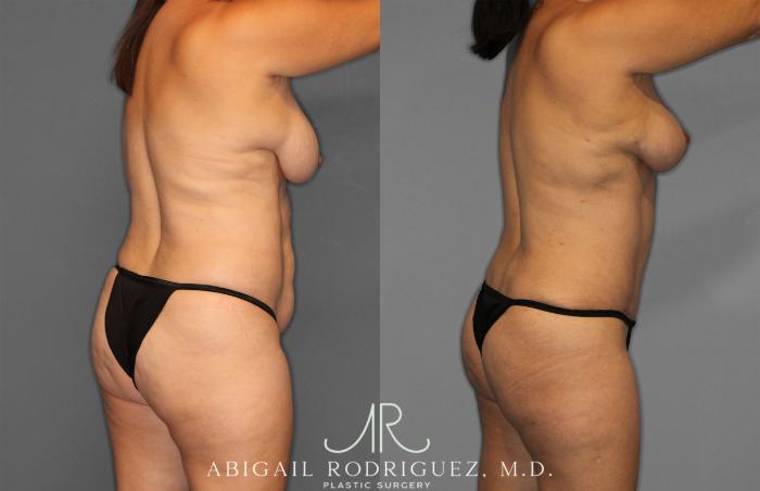 Before & After Tummy Tuck Case 257389 View 7 View in Houston, TX