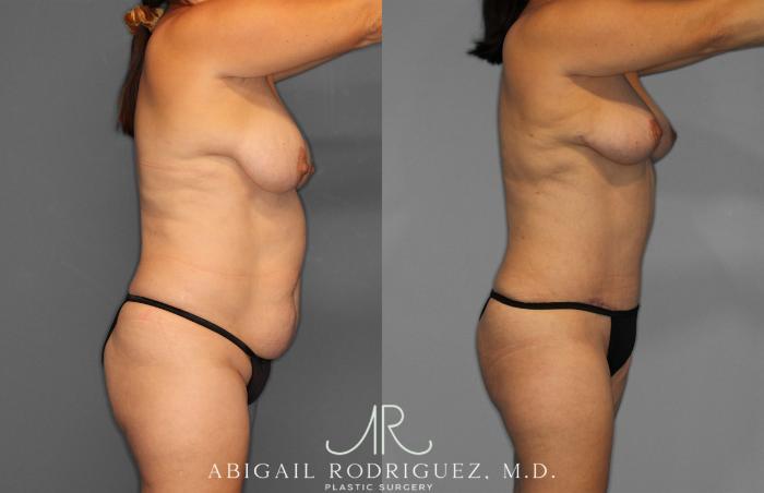 Before & After Tummy Tuck Case 257389 View 8 View in Houston, TX