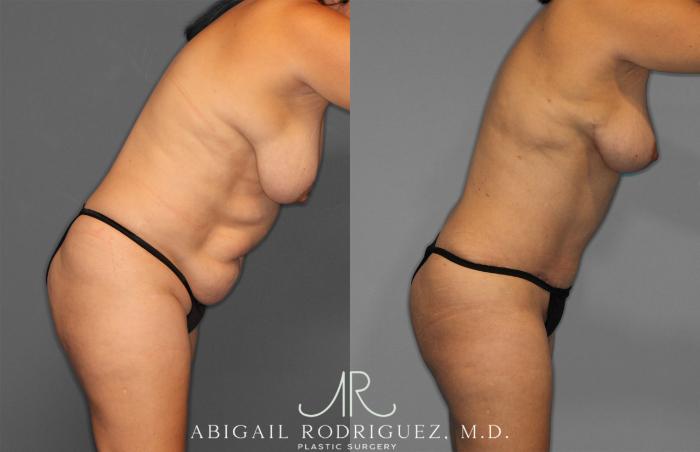 Before & After Tummy Tuck Case 257389 View 9 View in Houston, TX